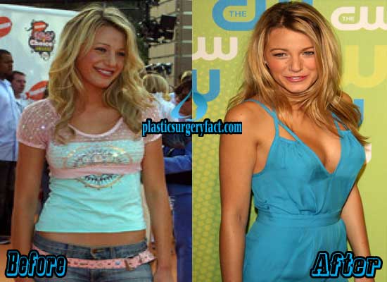 Blake Lively Plastic Surgery Before And After Photos 