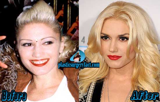 Gwen Stefani Plastic Surgery Before and After Photos