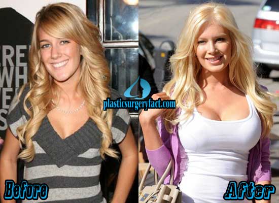 Heidi montag gets boob job