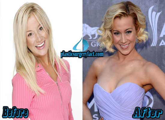 implants Kellie pickler