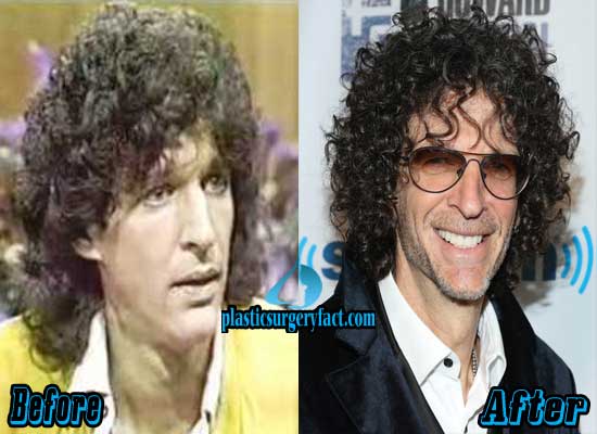 Howard Stern Plastic Surgery Before and After