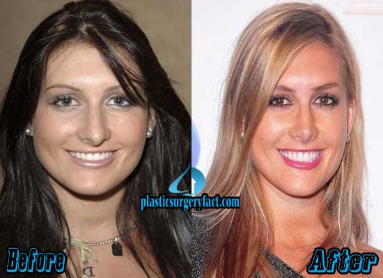 Jen Bunney Nose Job Before and After - Jen-Bunney-Nose-Job-Before-and-After