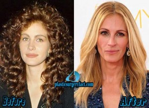 Julia Roberts Plastic Surgery Before And After Plastic Surgery Facts