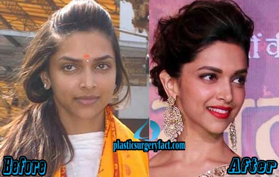 Deepika Padukone Plastic Surgery Before and After