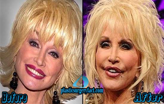 Dolly-Parton-Plastic-Surgery-Photos.jpg