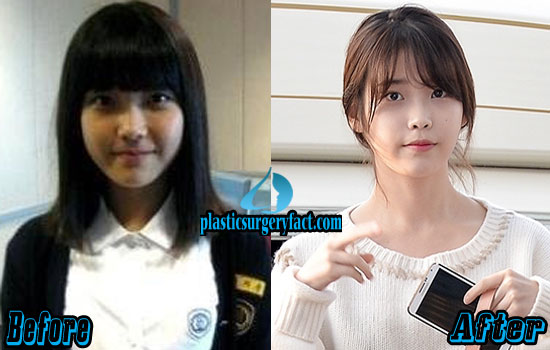 Plastic Surgery Before And After Korean Celebrities Diet