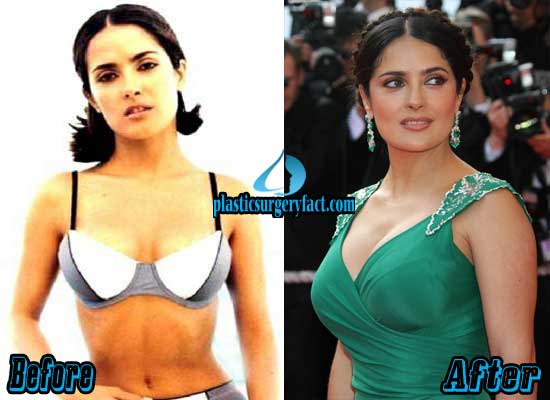 List Of Celebrities With Breast Implants Before And After Pictures