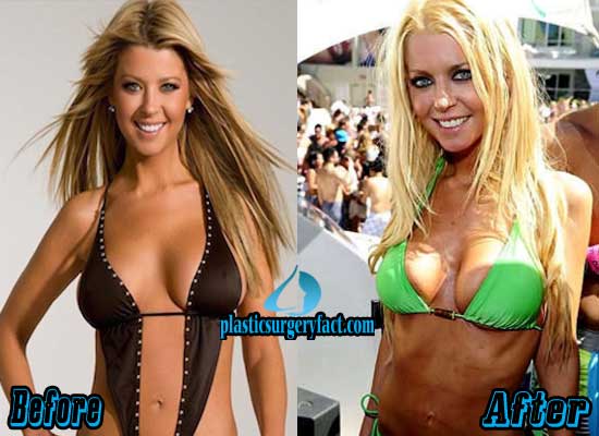 picture botched boob Tara reid job