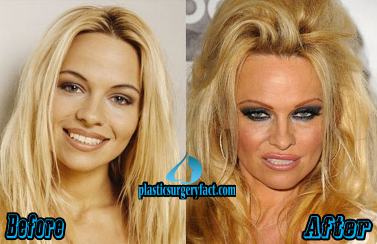 Too Much Plastic Surgery Before And After Worst