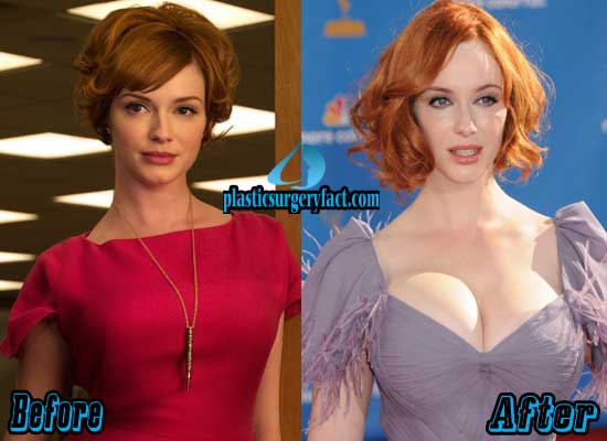 Christina Hendricks Breast Implants Before And After