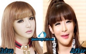 Park Bom Plastic Surgery Before and After Photos - Plastic Surgery Facts