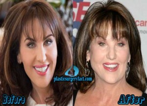 Robin McGraw Plastic Surgery Secrets? – Plastic Surgery Facts