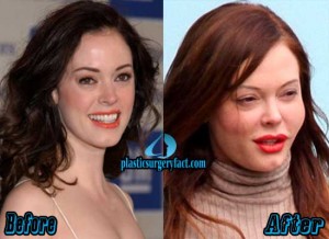 Rose McGowan Plastic Surgery Before and After Photos - Plastic Surgery ...