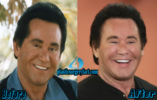 Wayne Newton Plastic Surgery Before and After Photos ...