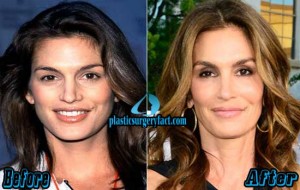 Cindy Crawford Plastic Surgery Before And After Photos - Plastic 