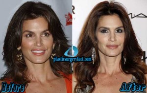 Cindy Crawford Plastic Surgery Before and After Photos - Plastic ...