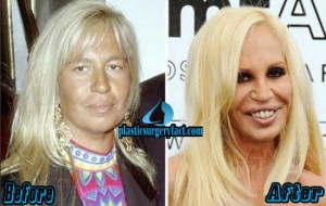 Donatella Versace Plastic Surgery Disaster – Plastic Surgery Facts