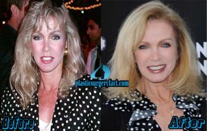 Donna Mills Plastic Surgery Before and After Photos