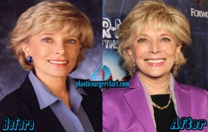 Leslie Stahl Plastic Surgery Before and After Photos - Plastic Surgery ...