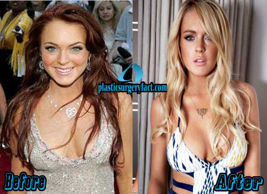 Lindsay Lohan Plastic Surgery Before and After Photos