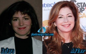 Dana Delany Plastic Surgery Before and After Photos - Plastic Surgery Facts