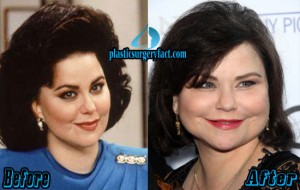 Delta Burke Plastic Surgery Before and After Pictures ...