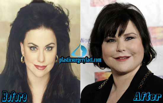 Delta Burke Plastic Surgery Before And. 