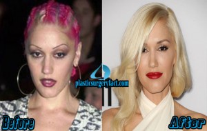 Gwen Stefani Plastic Surgery Before and After Photos – Plastic Surgery