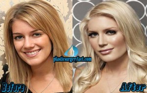 Heidi Montag Before And After Plastic Surgery
