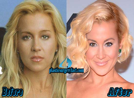 kellie pickler before and after surgery
