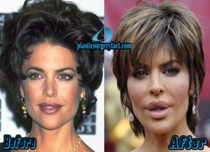 Lisa Rinna Plastic Surgery Before and After Photos - Plastic Surgery Facts