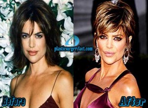 Lisa Rinna Plastic Surgery Before and After Photos - Plastic Surgery Facts