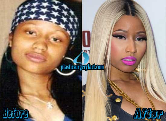 Nicki Minaj Before And After The Surgery