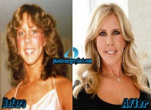 Vicki Gunvalson Plastic Surgery Before and After Photos
