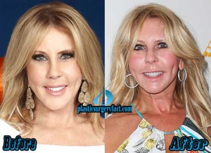 Vicki Gunvalson Plastic Surgery Before and After Photos - Plastic ...