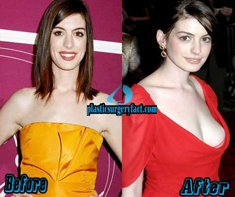 Anne Hathaway Plastic Surgery Before After - Plastic Surgery