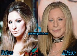 Barbra Streisand Plastic Surgery Before and After Pictures - Plastic ...