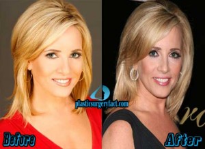 Jamie Colby Plastic Surgery Before and After - Plastic Surgery Facts