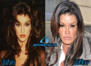 Top 10 Pictures of Celebrity Plastic Surgery Gone Wrong - Plastic ...