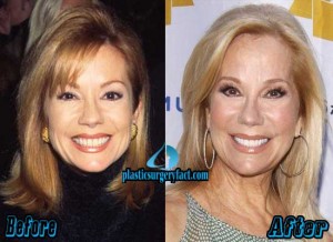 Kathie Lee Gifford Plastic Surgery Before and After - Plastic Surgery Facts