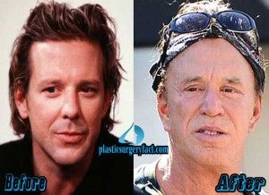 Mickey Rourke Plastic Surgery Gone Wrong - Plastic Surgery Facts