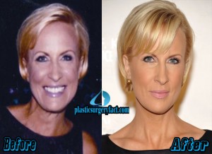 Mika Brzezinski Plastic Surgery Before and After Pictures - Plastic ...