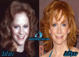 Reba McEntire Plastic Surgery Before and After Photos