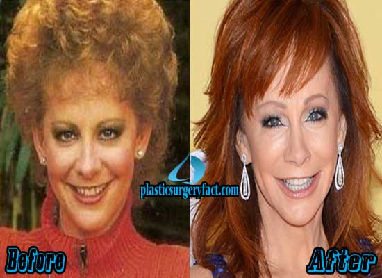 Reba McEntire Plastic Surgery Before and After Photos