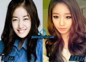 T-ara Jiyeon Plastic Surgery Before and After