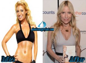 Tracy Anderson Plastic Surgery Before and After