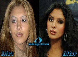 Vanessa Bryant Plastic Surgery Before and After Pictures - Plastic