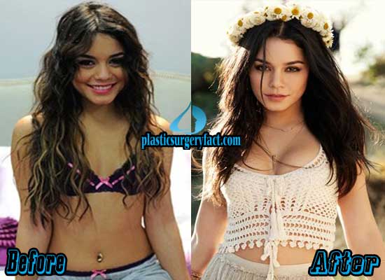Vanessa Hudgens Breast Implants Before and After.