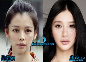 Vivian Hsu Plastic Surgery Before and After Photos