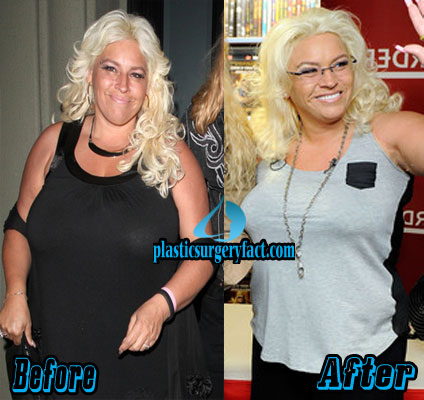 Beth Chapman Plastic Surgery Secrets Revealed - Plastic ...